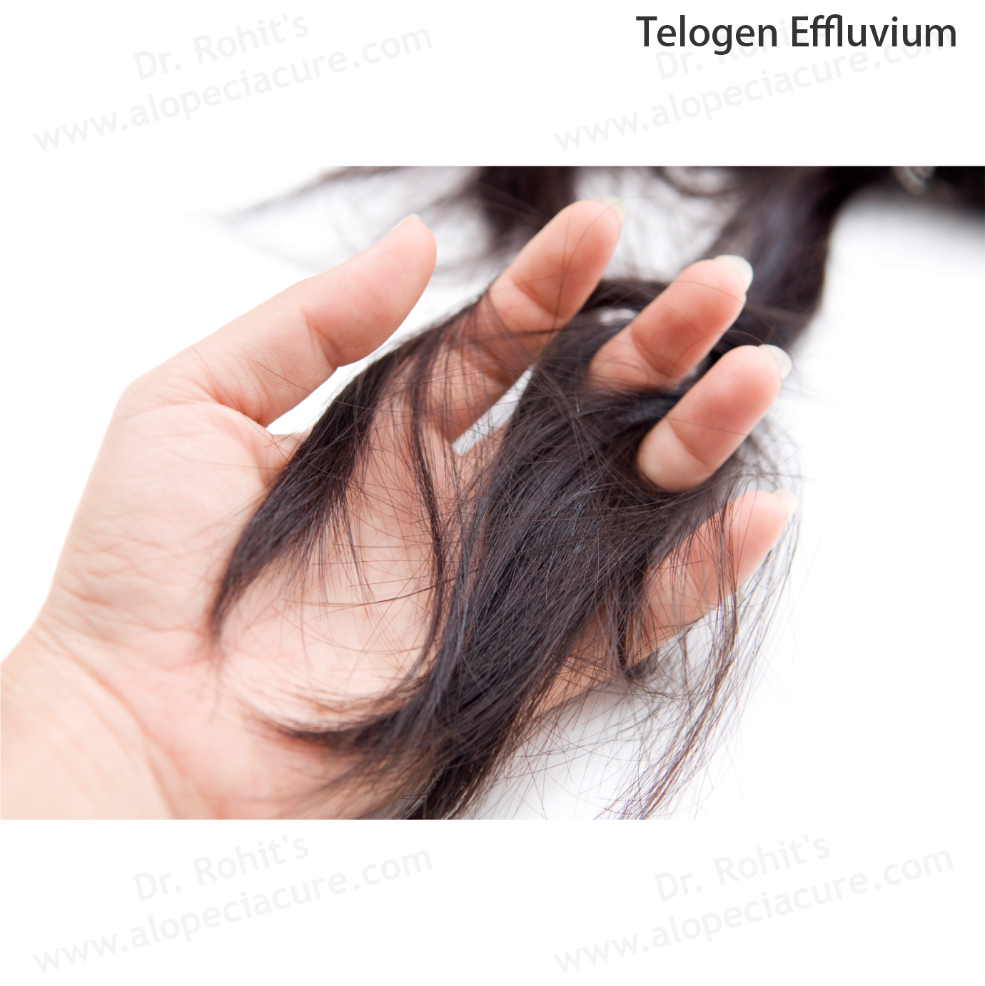Telogen Effluvium Clinical Treatment Slide 2
