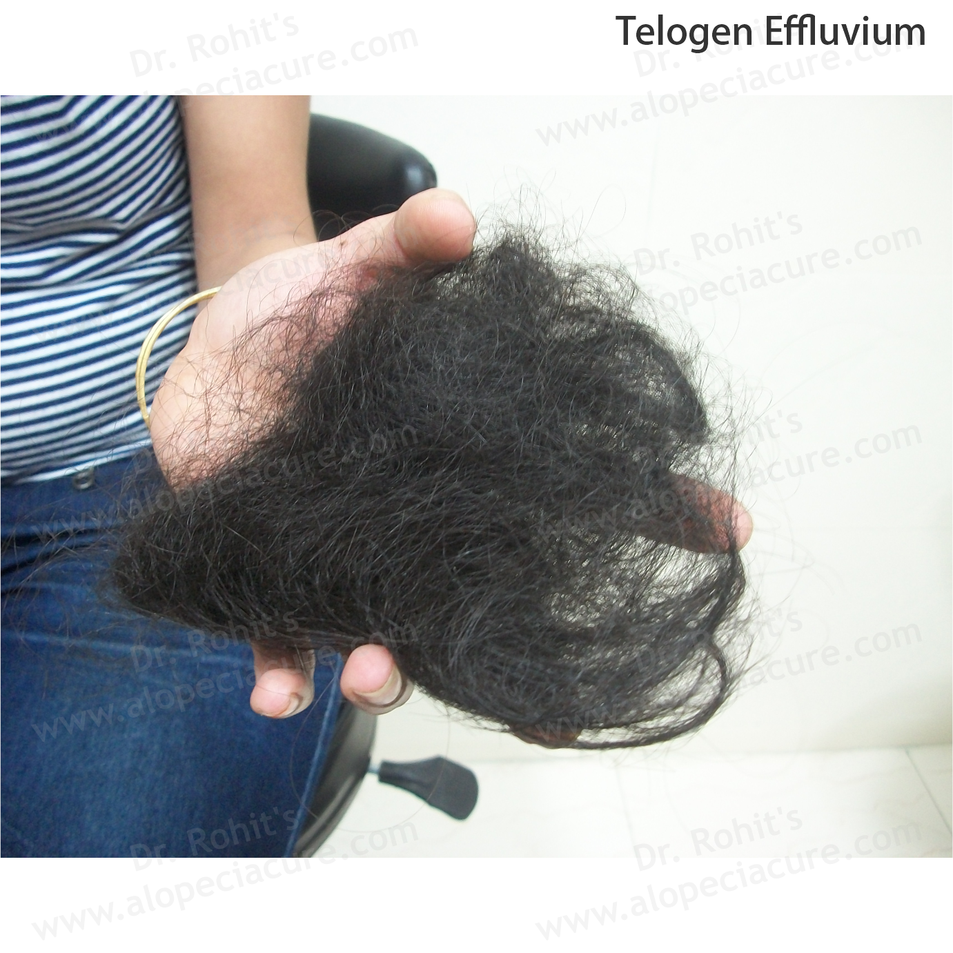Telogen Effluvium Clinical Treatment Slide 4