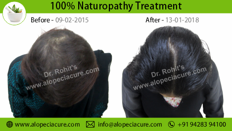 Telogen Effluvium Treatment Result 1
