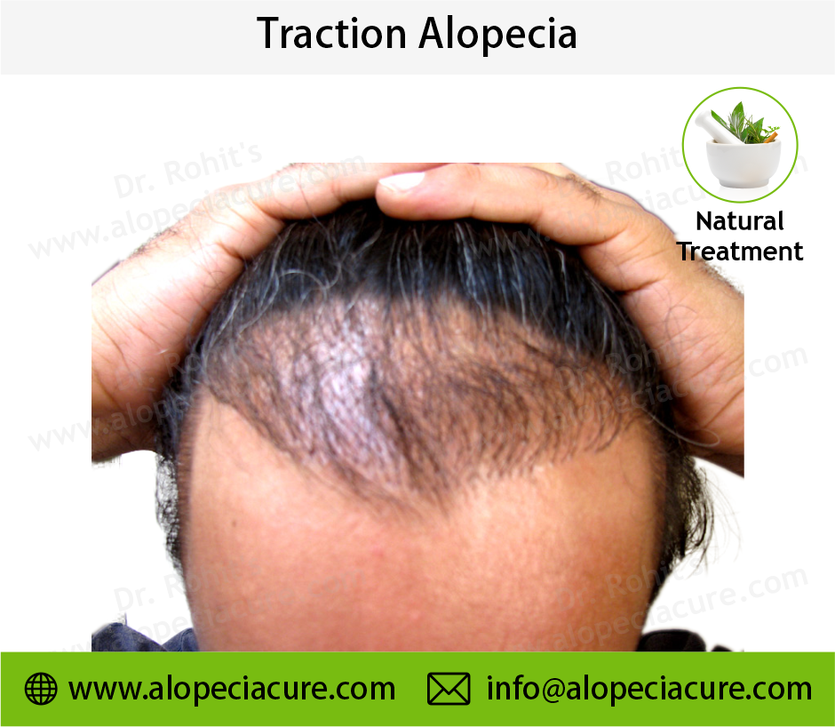 Traction Alopecia Result 1