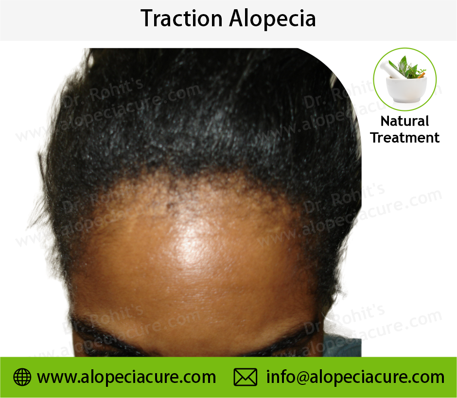 Traction Alopecia Result 2