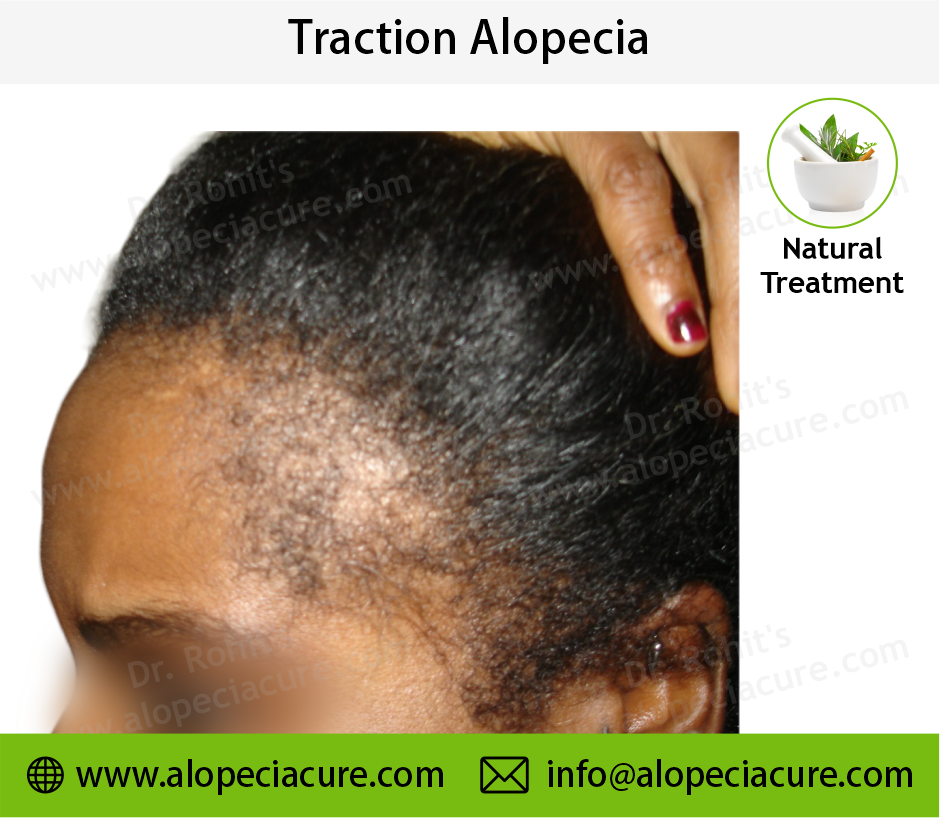 Traction Alopecia Result 3