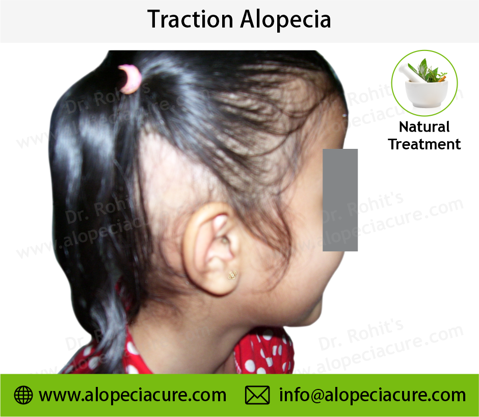 Traction Alopecia Result 4
