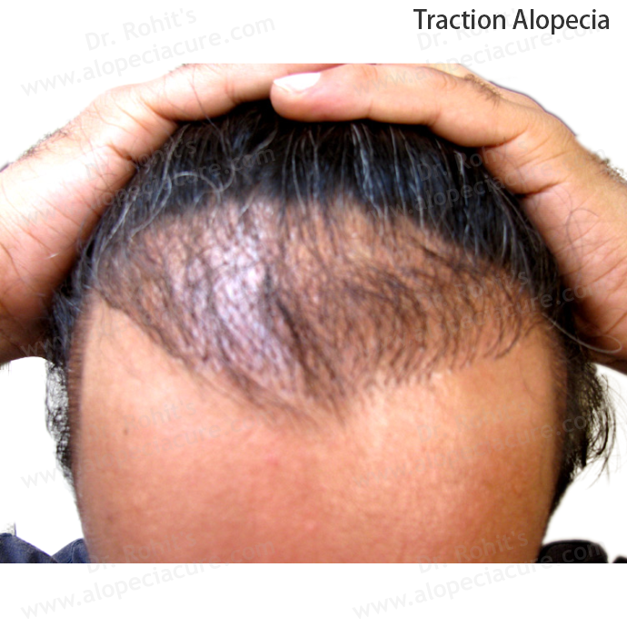 Traction Alopecia Clinical Treatment Slide 1