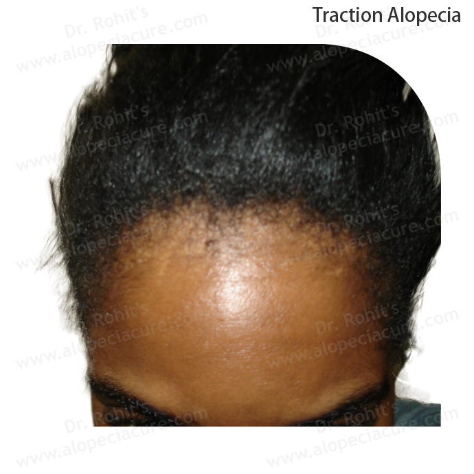 Traction Alopecia Clinical Treatment Slide 2