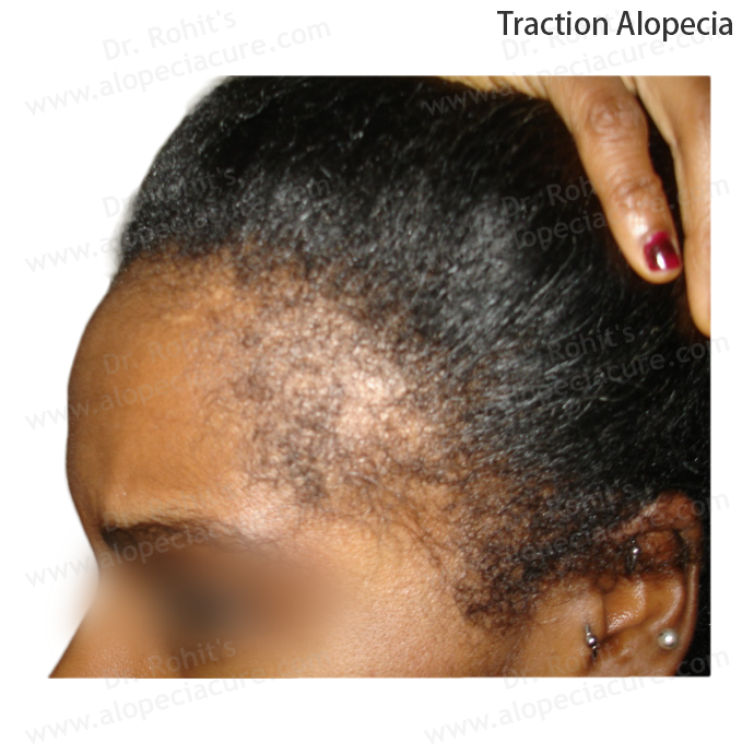Traction Alopecia Clinical Treatment Slide 3