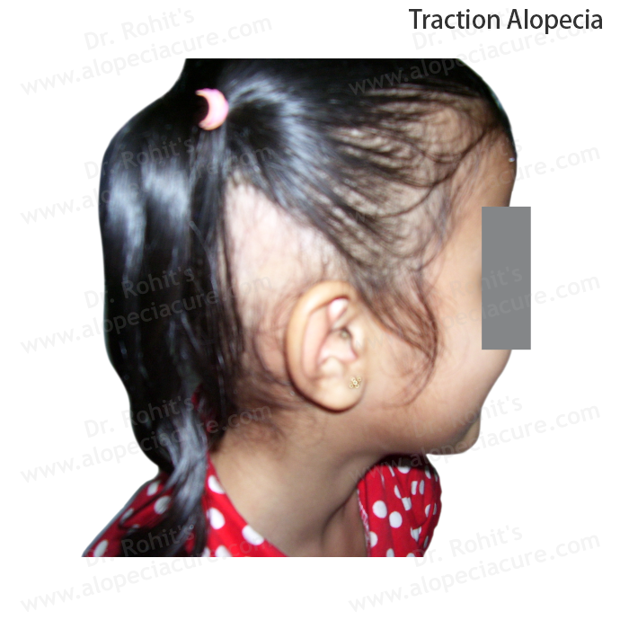 Traction Alopecia Clinical Treatment Slide 4