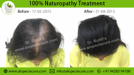 Traction Alopecia Treatment Result 2