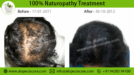 Traction Alopecia Treatment Result 3