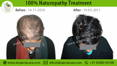 Traction Alopecia Treatment Result 4