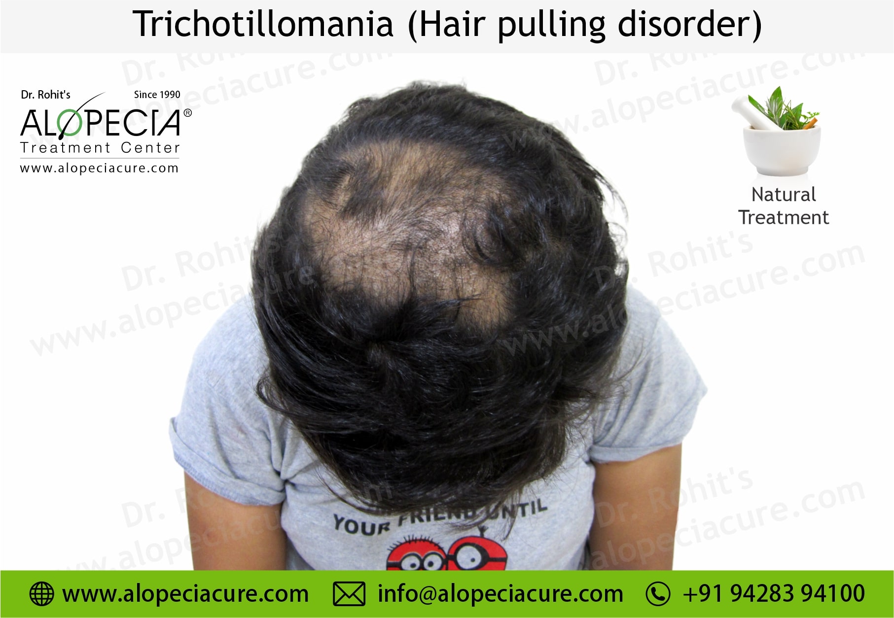 Clinical Overview of Trichotillomania