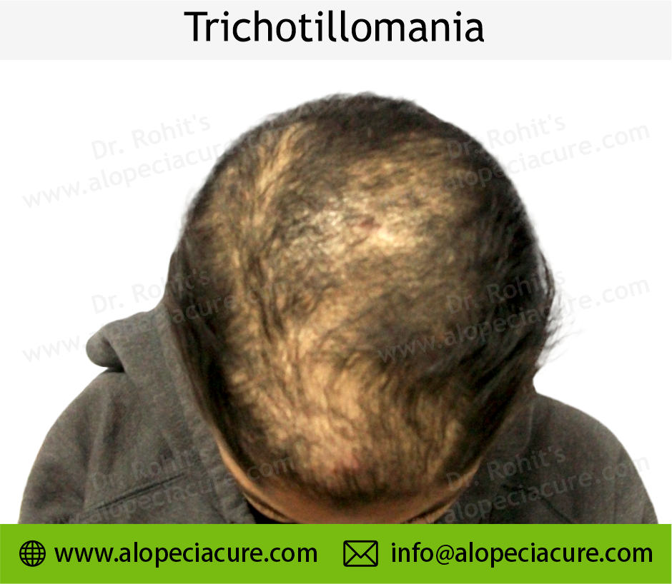 Trichotillomania Treatment Result 1