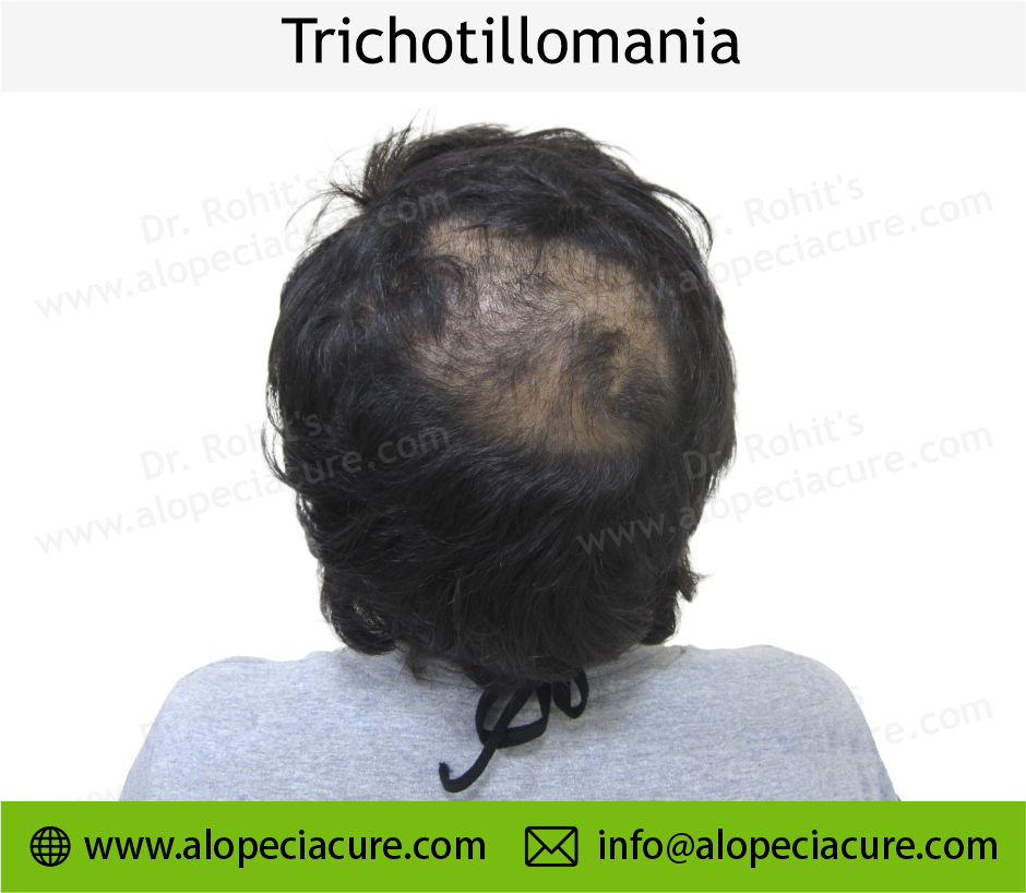 Trichotillomania Treatment Result 2