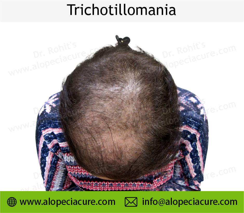 Trichotillomania Treatment Result 3