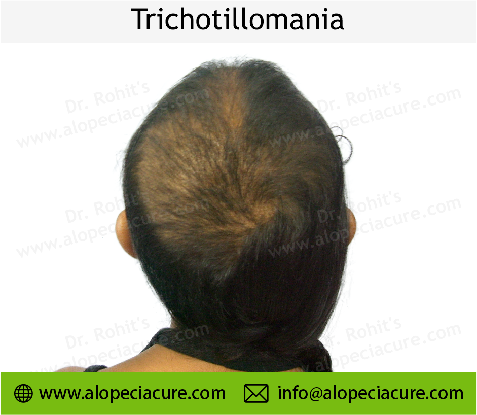 Trichotillomania Treatment Result 4