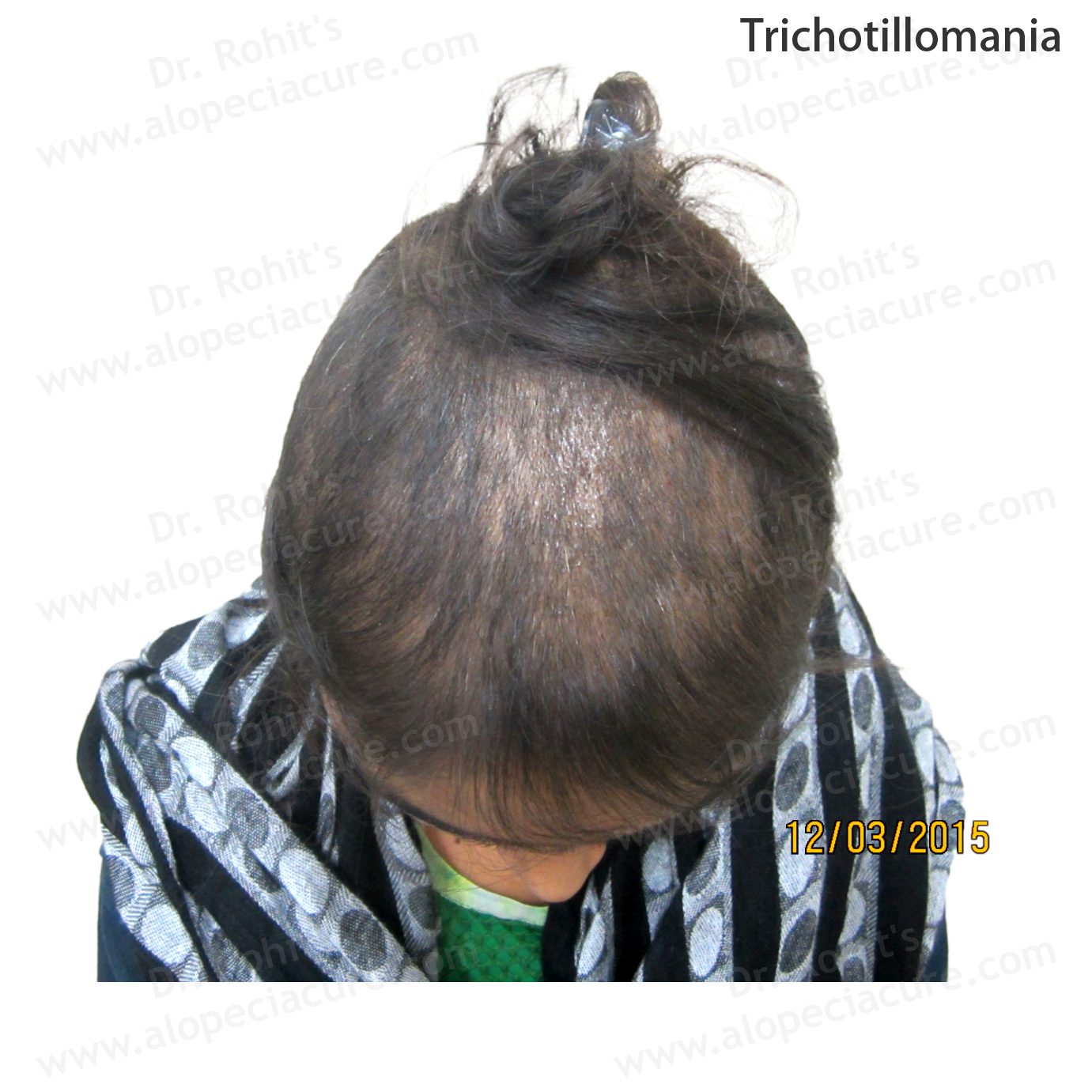 Trichotillomania Clinical Treatment Slide 1