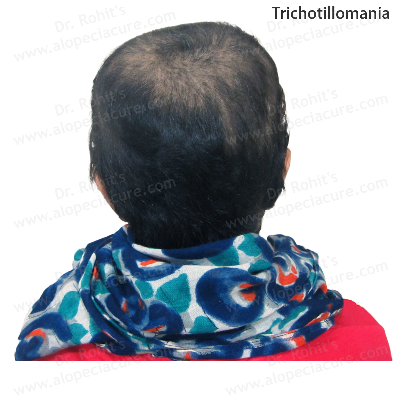 Trichotillomania Clinical Treatment Slide 2