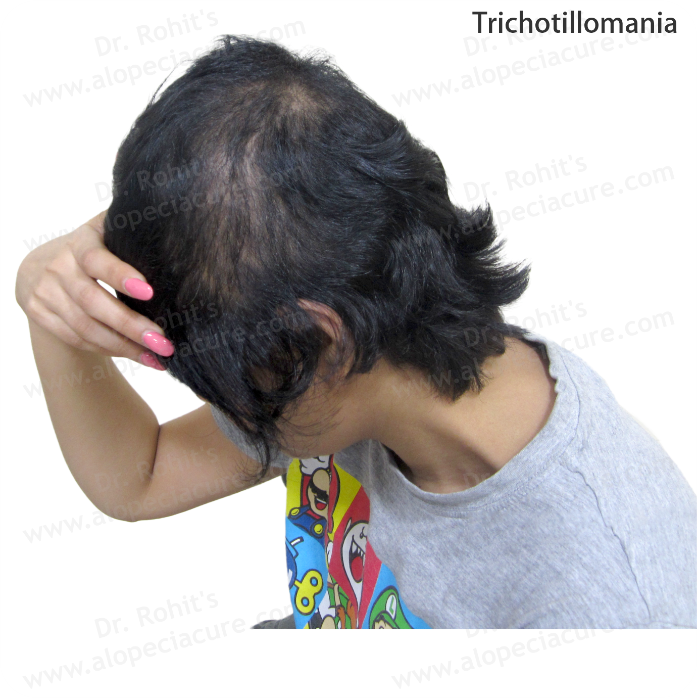 Trichotillomania Clinical Treatment Slide 3