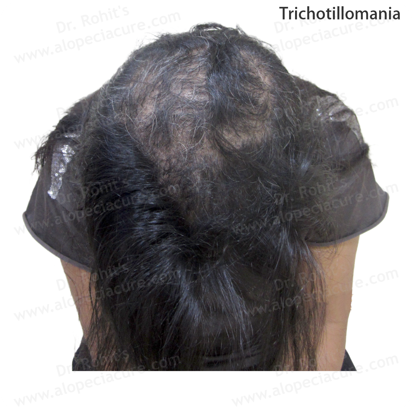 Trichotillomania Clinical Treatment Slide 4