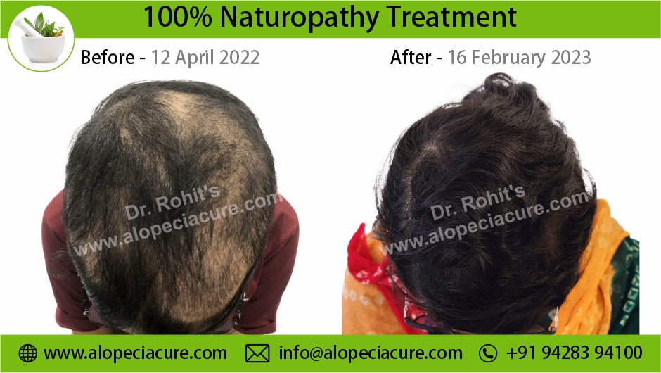 Trichotillomania Treatment Result 1