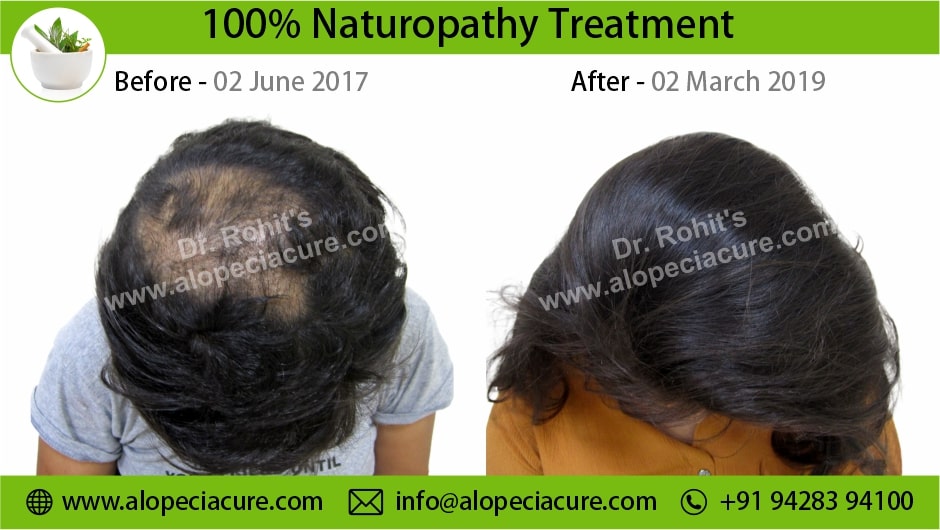 Trichotillomania Treatment Result 2