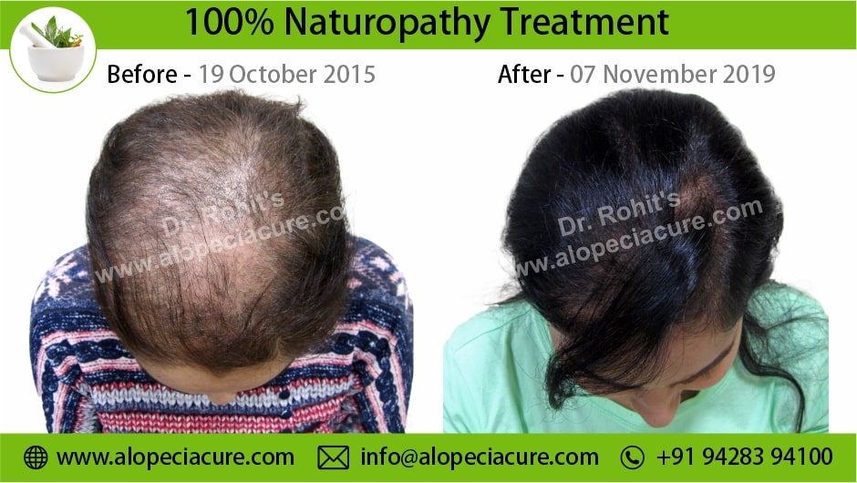 Trichotillomania Treatment Result 3