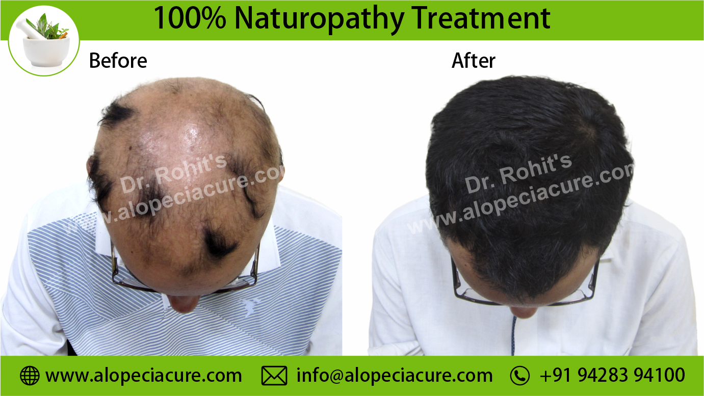 Alopecia Areata Result 1