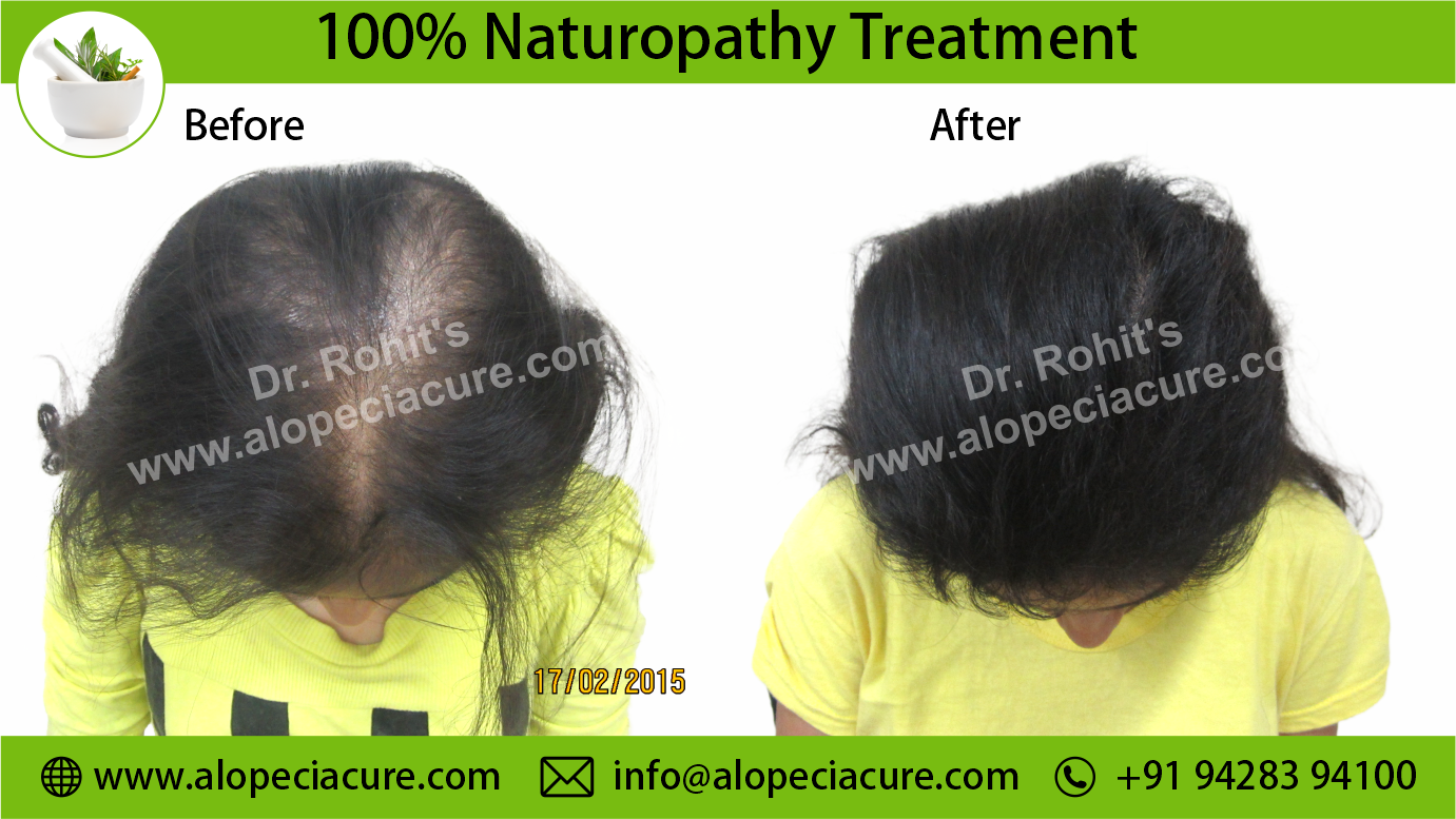 Alopecia Areata Result 2