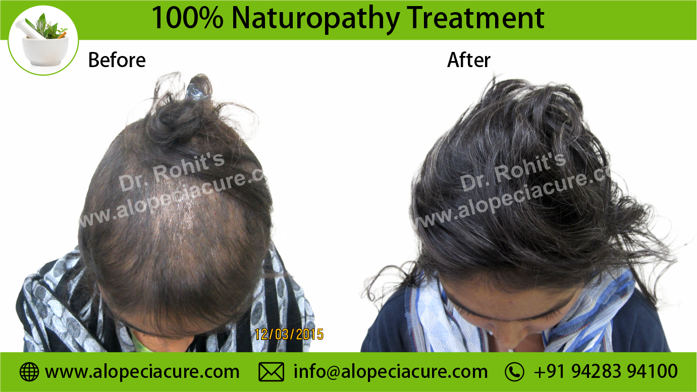 Alopecia Areata Result 3