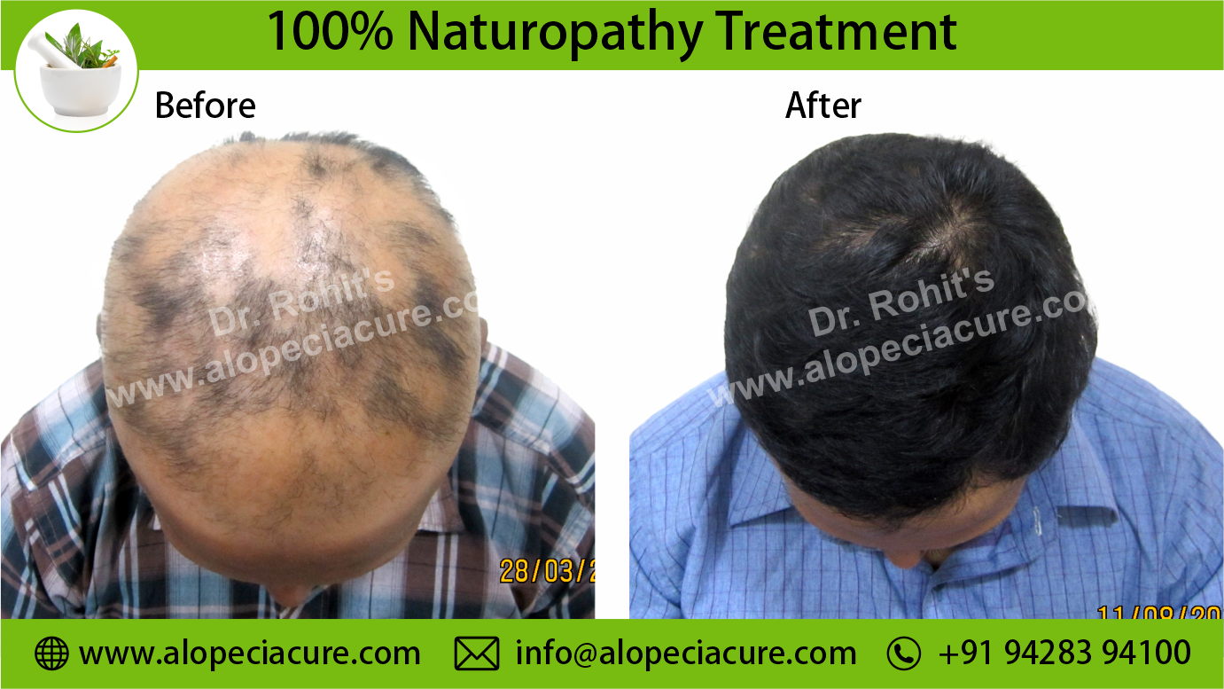 Alopecia Areata Result 4