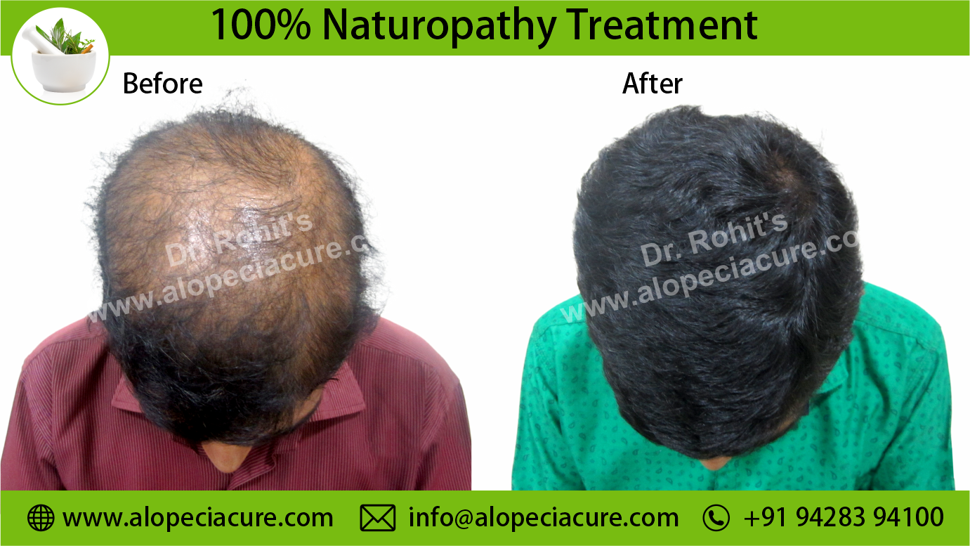 Alopecia Areata Result 5
