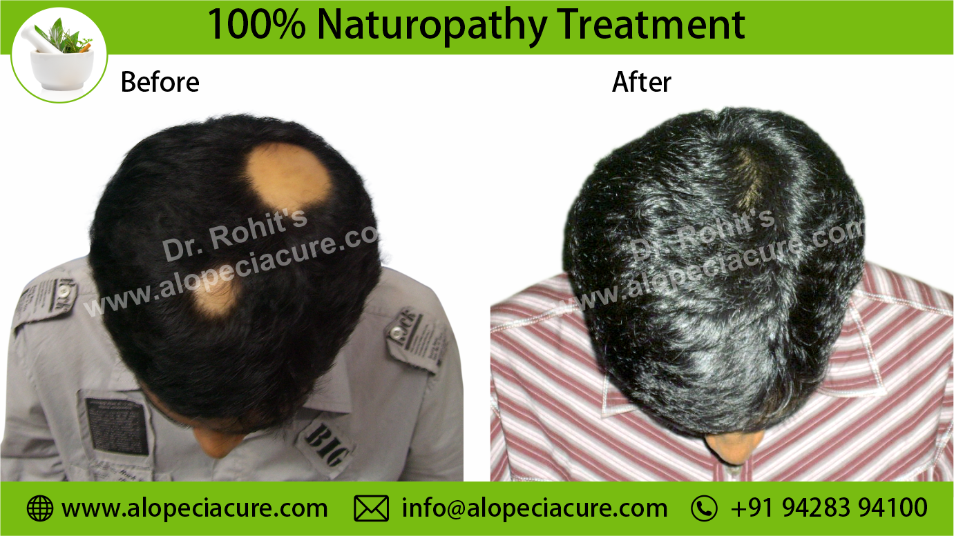 Alopecia Areata Result 6