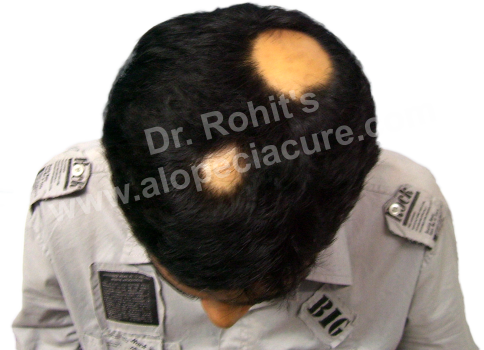 Alopecia Areata