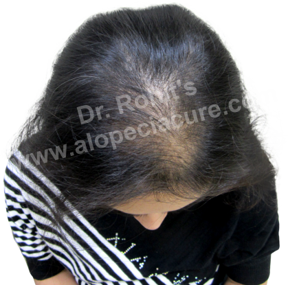 Female Hair Loss