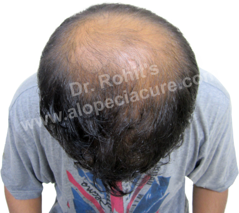 Male Hair Loss