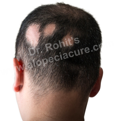 Scarring Alopecia