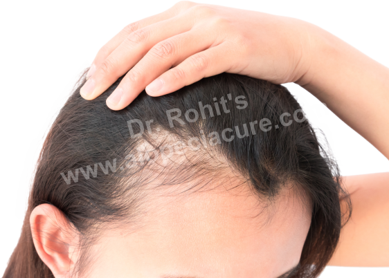 Telogen Effluvium