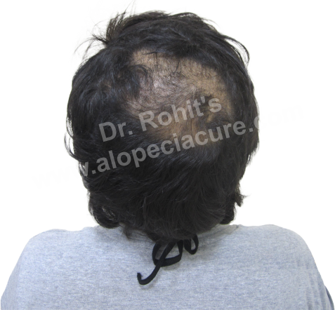 Traction Alopecia