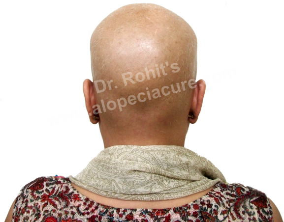 Chemotherapy Hair Loss